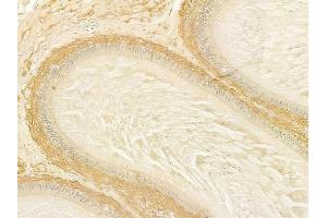 ABIN6259995 and ABIN6279131 at 1/100 staining human testicular cancer by IHC-P. (APOL3 抗体  (N-Term))