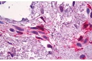 Anti-F13A1 / Factor XIIIa antibody IHC staining of human skin, dermal inflammatory cells. (F13A1 抗体)