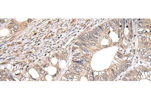 Immunohistochemistry of paraffin-embedded Human colorectal cancer tissue using GCNT2 Polyclonal Antibody at dilution of 1:60(x200)