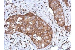 IHC-P Image Immunohistochemical analysis of paraffin-embedded human breast cancer, using CD97, antibody at 1:500 dilution. (CD97 抗体)