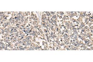 Immunohistochemistry of paraffin-embedded Human esophagus cancer tissue using C12orf40 Polyclonal Antibody at dilution of 1:50(x200) (C12orf40 抗体)