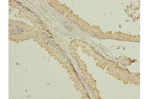 Immunohistochemistry of paraffin-embedded human prostate cancer using ABIN7173055 at dilution of 1:100 (TMEM140 抗体  (AA 33-77))