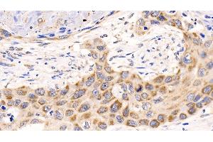 Detection of MCL1 in Human Lung cancer Tissue using Polyclonal Antibody to Induced Myeloid Leukemia Cell Differentiation Protein Mcl-1 (MCL1) (MCL-1 抗体  (AA 2-307))