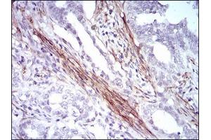 Immunohistochemical analysis of paraffin-embedded cervical cancer tissues using CNN1 mouse mAb with DAB staining. (CNN1 抗体  (AA 16-165))