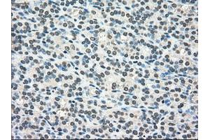 Immunohistochemical staining of paraffin-embedded Adenocarcinoma of colon tissue using anti-SCYL3mouse monoclonal antibody. (SCYL3 抗体)
