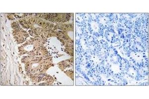 Immunohistochemistry analysis of paraffin-embedded human colon carcinoma tissue, using ZC3H8 Antibody. (ZC3H8 抗体  (AA 81-130))