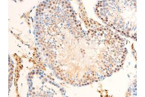 Immunohistochemistry (IHC) image for anti-Receptor tyrosine-protein kinase erbB-2 (ErbB2/Her2) (pTyr1248) antibody (ABIN6256630)