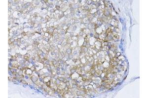 Immunohistochemistry of paraffin-embedded human breast cancer using BRCA1 antibody. (BRCA1 抗体  (AA 120-220))