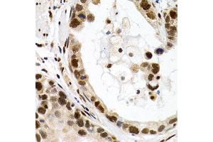 Immunohistochemistry of paraffin-embedded human stomach cancer using MT2A antibody at dilution of 1:200 (400x lens). (MT2A 抗体)