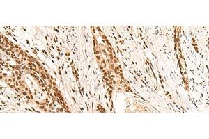 Immunohistochemistry of paraffin-embedded Human esophagus cancer tissue using RMND5B Polyclonal Antibody at dilution of 1:50(x200) (RMND5B 抗体)