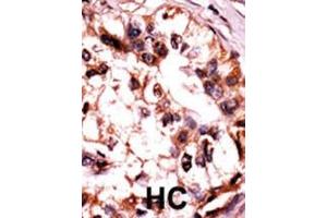 Formalin-fixed and paraffin-embedded human cancer tissue reacted with the primary antibody, which was peroxidase-conjugated to the secondary antibody, followed by AEC staining. (MAPK6 抗体  (pSer189))