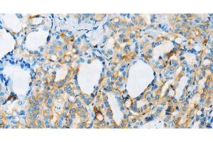 Immunohistochemistry of paraffin-embedded Human thyroid cancer tissue using ARSA Polyclonal Antibody at dilution 1:50 (Arylsulfatase A 抗体)