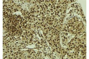 ABIN6278630 at 1/100 staining Human breast cancer tissue by IHC-P. (URI1 抗体  (Internal Region))