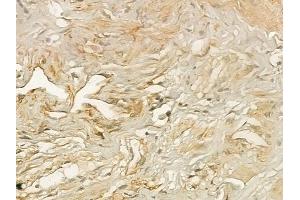 ABIN6258113 and ABIN6273354 at 1/100 staining human testicular cancer by IHC-P. (DIRAS3 抗体  (C-Term))