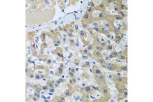 Immunohistochemistry of paraffin-embedded human liver cancer using XPC antibody. (XPC 抗体  (AA 700-940))