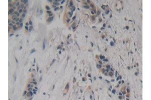 Detection of NSE in Human Breast cancer Tissue using Polyclonal Antibody to Enolase, Neuron Specific (NSE) (ENO2/NSE 抗体  (AA 2-285))