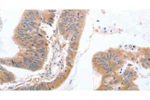 Immunohistochemistry of paraffin-embedded Human colon cancer tissue using TGFA Polyclonal Antibody at dilution 1:60