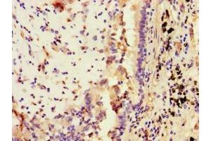 Immunohistochemistry of paraffin-embedded human lung cancer using ABIN7169671 at dilution of 1:100 (STAT2 抗体  (AA 571-851))