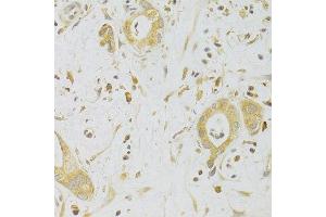 Immunohistochemistry of paraffin-embedded human liver cancer using CASP2 Antibody. (Caspase 2 抗体  (AA 153-452))