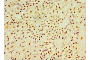 Immunohistochemistry of paraffin-embedded human breast cancer using ABIN7145488 at dilution of 1:100 (DEFB4A 抗体  (AA 1-64))