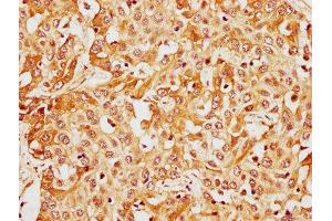 IHC image of ABIN7148386 diluted at 1:400 and staining in paraffin-embedded human liver cancer performed on a Leica BondTM system. (CFHR1 抗体  (AA 132-221))