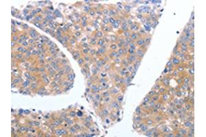 The image on the left is immunohistochemistry of paraffin-embedded Human breast cancer tissue using ABIN7190790(GFRA4 Antibody) at dilution 1/40, on the right is treated with synthetic peptide. (GFRA4 抗体)