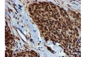 Immunohistochemical staining of paraffin-embedded Adenocarcinoma of Human breast tissue using anti-GSTT2 mouse monoclonal antibody. (GSTT2 抗体)