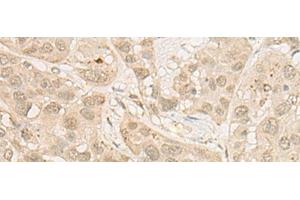Immunohistochemistry of paraffin-embedded Human esophagus cancer tissue using RSU1 Polyclonal Antibody at dilution of 1:30(x200) (RSU1 抗体)
