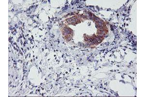 Immunohistochemical staining of paraffin-embedded Carcinoma of Human pancreas tissue using anti-NMT2 mouse monoclonal antibody. (NMT2 抗体)