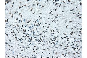 Immunohistochemical staining of paraffin-embedded Adenocarcinoma of colon tissue using anti-BRAFmouse monoclonal antibody. (BRAF 抗体)