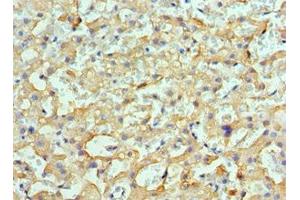 Immunohistochemistry of paraffin-embedded human liver cancer using ABIN7154901 at dilution of 1:100 (HSPH1 抗体  (AA 659-858))