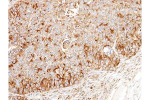 IHC-P Image Immunohistochemical analysis of paraffin-embedded SW480 xenograft, using BCKDK, antibody at 1:100 dilution. (BCKDK 抗体)