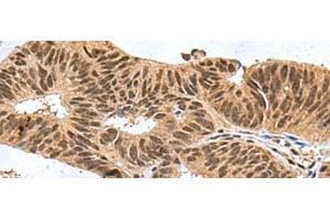 Immunohistochemistry of paraffin-embedded Human colorectal cancer tissue using FBXO32 Polyclonal Antibody at dilution of 1:60(x200) (FBXO32 抗体)