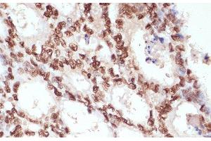 Immunohistochemistry of paraffin-embedded Human colon carcinoma using Phospho-β-catenin(S33/S37/T41) Polyclonal Antibody at dilution of 1:100 (40x lens). (beta Catenin 抗体  (pSer33, pSer37, pThr41))