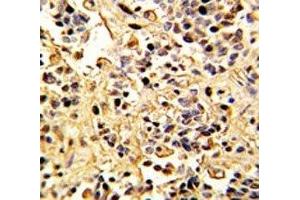 IHC analysis of FFPE human kidney carcinoma with Neprilysin antibody (MME 抗体  (AA 506-534))