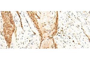 Immunohistochemistry of paraffin-embedded Human esophagus cancer tissue using EMSY Polyclonal Antibody at dilution of 1:25(x200) (EMSY 抗体)