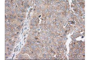 Immunohistochemical staining of paraffin-embedded Adenocarcinoma of Human colon tissue using anti-SNX9 mouse monoclonal antibody.
