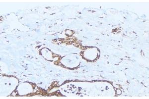 ABIN6275413 at 1/100 staining Human lung cancer tissue by IHC-P. (PPM1K 抗体  (Internal Region))