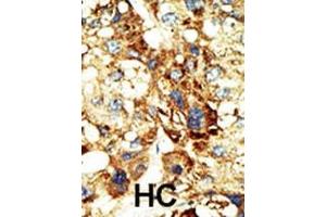 Formalin-fixed and paraffin-embedded human cancer tissue reacted with the primary antibody, which was peroxidase-conjugated to the secondary antibody, followed by DAB staining. (DNMT3A 抗体  (AA 457-486))