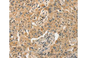 Immunohistochemistry of Human esophagus cancer using SLC11A2 Polyclonal Antibody at dilution of 1:50 (SLC11A2 抗体)