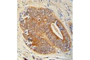 Immunohistochemistry analysis in formalin fixed and paraffin embedded human prostate carcinoma reacted with GAGE7 Antibody (C-term) followed by peroxidase conjugation of the secondary antibody and DAB staining. (G Antigen 7 抗体  (C-Term))