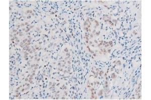 ABIN6267555 at 1/200 staining Human ganstric cancer tissue sections by IHC-P.