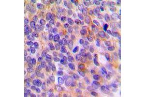 Immunohistochemical analysis of TOLLIP staining in human breast cancer formalin fixed paraffin embedded tissue section. (TOLLIP 抗体  (Center))