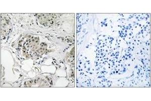 Immunohistochemistry analysis of paraffin-embedded human breast carcinoma tissue, using USP13 Antibody. (USP13 抗体  (AA 811-860))