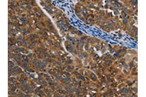 The image on the left is immunohistochemistry of paraffin-embedded Human ovarian cancer tissue using ABIN7129016(COX6B2 Antibody) at dilution 1/50, on the right is treated with fusion protein. (COX6B2 抗体)