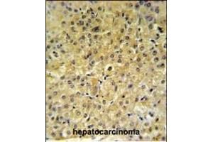 INSC Antibody (Center) (ABIN653657 and ABIN2842997) IHC analysis in formalin fixed and paraffin embedded hepatocarcinoma followed by peroxidase conjugation of the secondary antibody and DAB staining. (INSC 抗体  (AA 410-437))