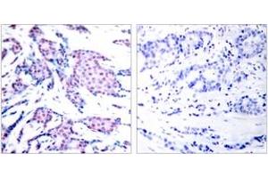 Immunohistochemistry analysis of paraffin-embedded human breast carcinoma, using c-Jun (Phospho-Thr93) Antibody. (C-JUN 抗体  (pThr93))