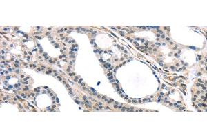 Immunohistochemistry of paraffin-embedded Human thyroid cancer tissue using KDM5C Polyclonal Antibody at dilution 1:45 (KDM5C 抗体)