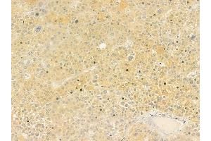 ABIN6260416 and ABIN6279231 at 1/100 staining human hepatocellular carcinoma by IHC-P. (CALML6 抗体  (Internal Region))