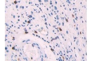 Detection of PF4 in Human Stomach cancer Tissue using Polyclonal Antibody to Platelet Factor 4 (PF4) (PF4 抗体  (AA 31-101))